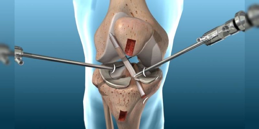 Ilustración 3D de artroscopia de rodilla